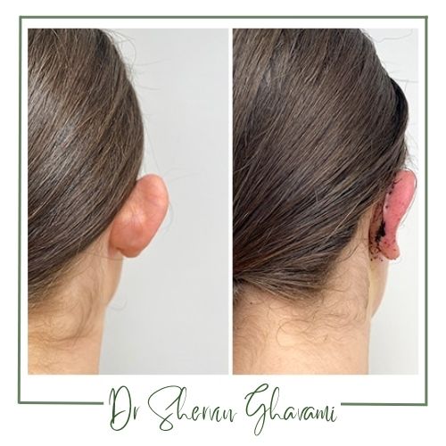 عوارض احتمالی جراحی اصلاح فرم گوش عوارض احتمالی جراحی اصلاح فرم گوش