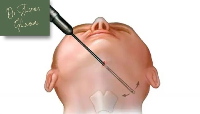عوارض برداشتن چربی زیر چانه