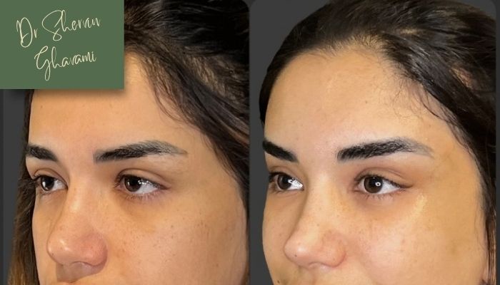 نتایج و دوام اثر لیفت بر افتادگی ابرو