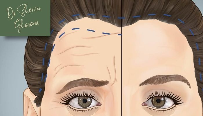 آیا بعد از لیفت شقیقه فرم چشم تغییر می‌کند؟ 