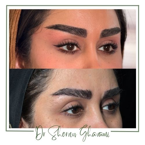 مزایای لیفت گوشه چشم