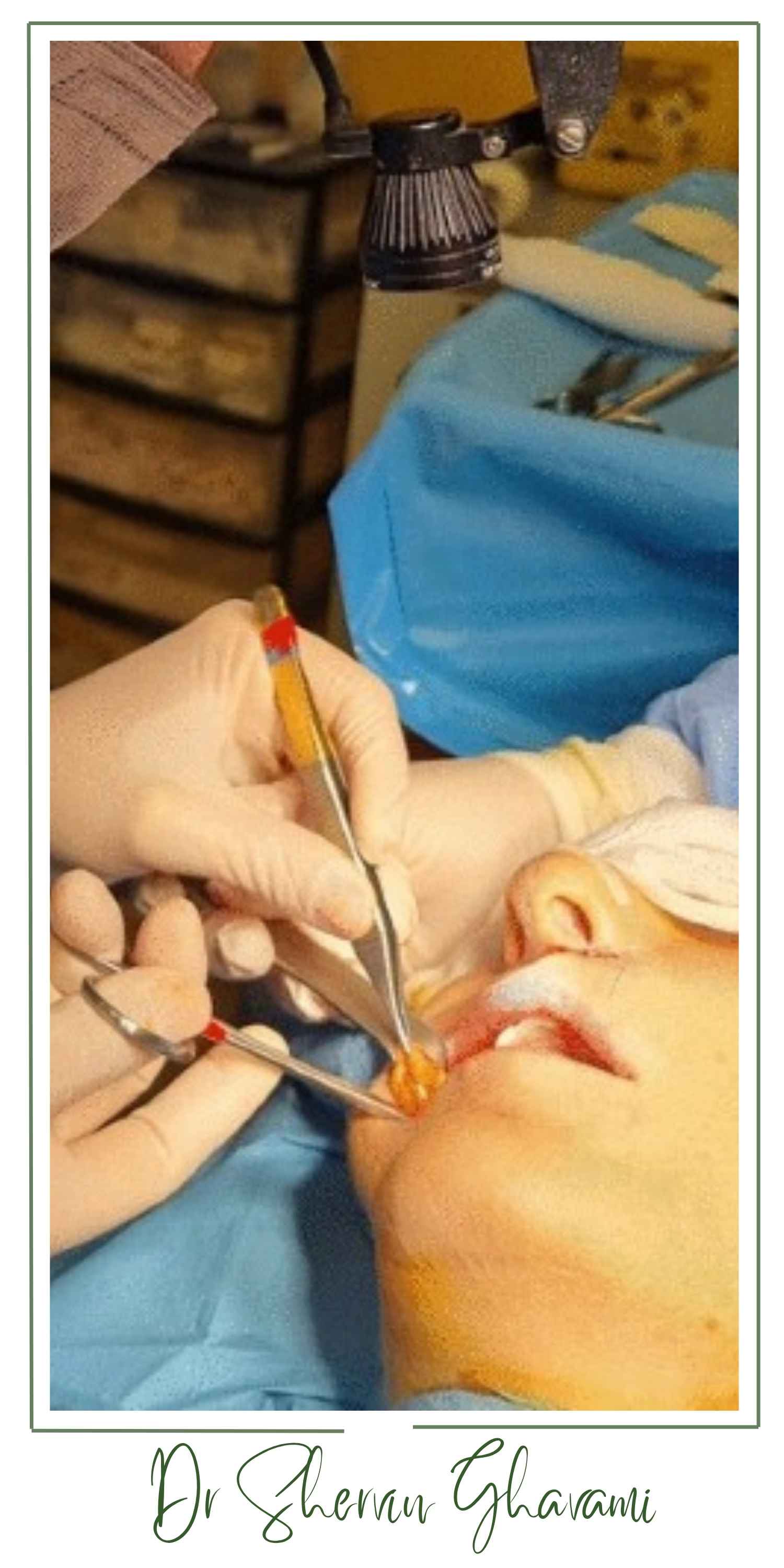 چگونگی عمل بوکال فت