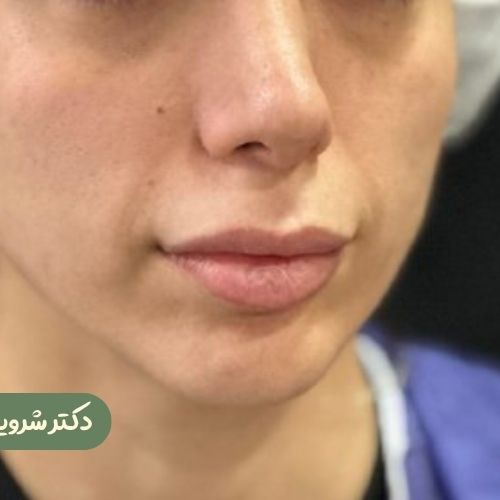 قبل از سانترال لب