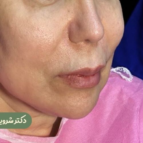 قبل از سانترال لب