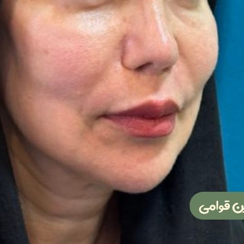 بعد از سانترال لب