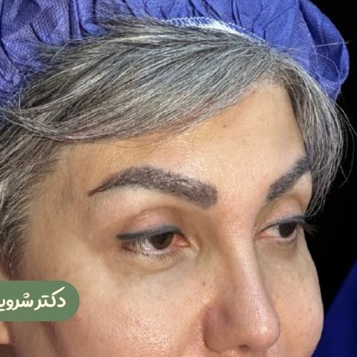قبل از لیفت شقیقه