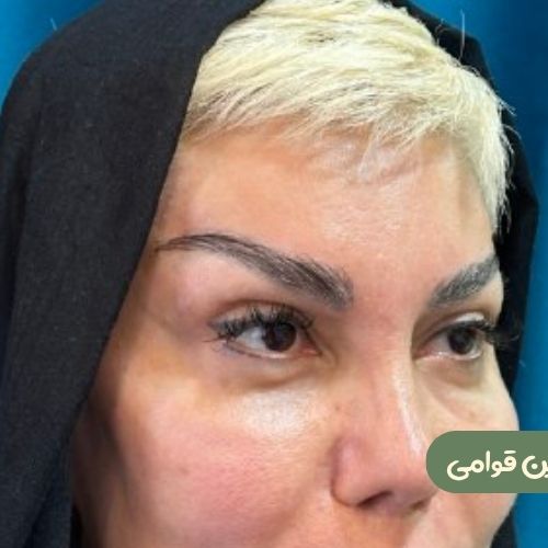 بعد از لیفت شقیقه