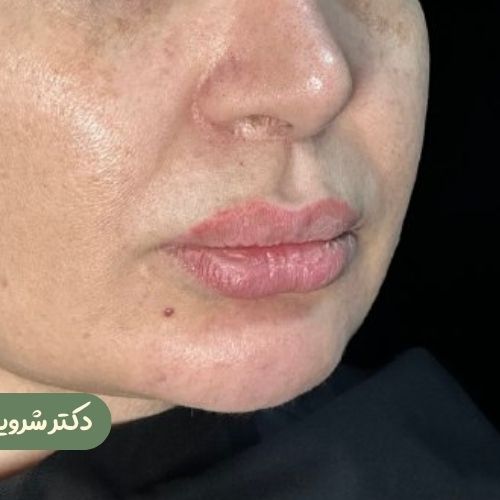 قبل از سانترال لب