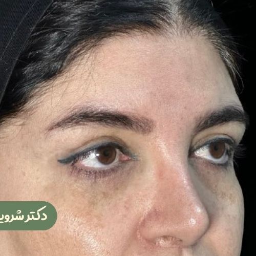 قبل از لیفت شقیقه