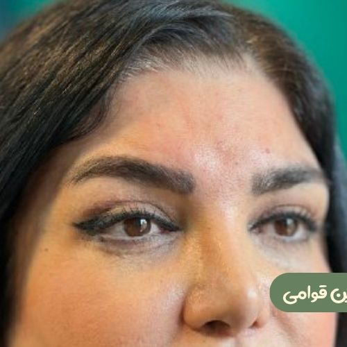 بعد از لیفت شقیقه