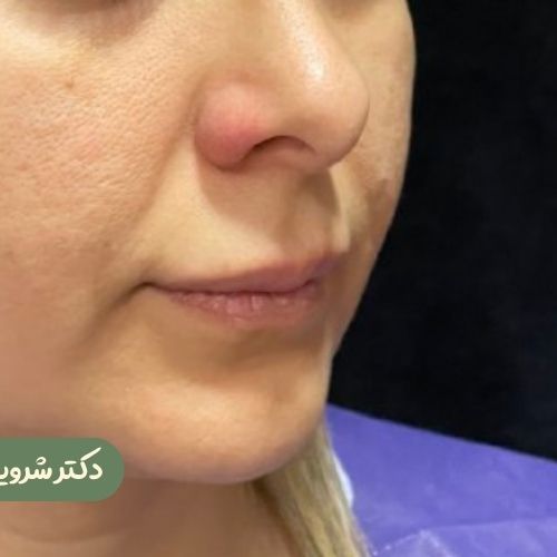 قبل از سانترال لب