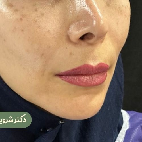 قبل از سانترال لب
