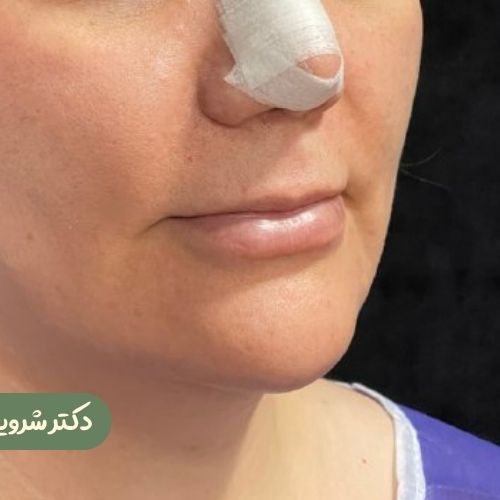 قبل از سانترال لب