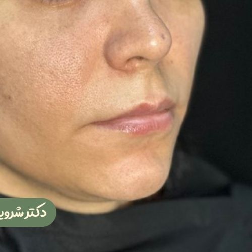 قبل از سانترال لب