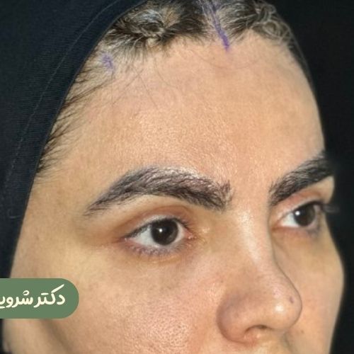 قبل از لیفت شقیقه
