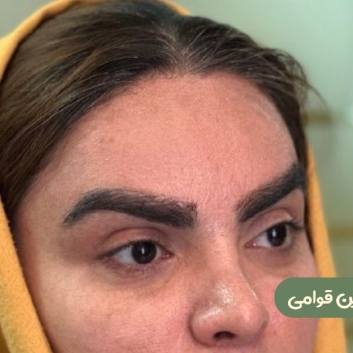 بعد از لیفت شقیقه