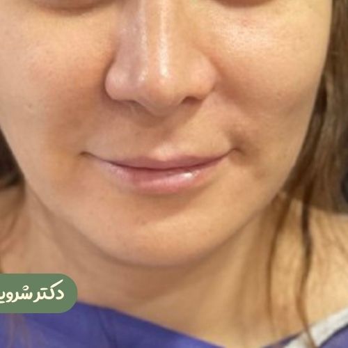 قبل از سانترال لب