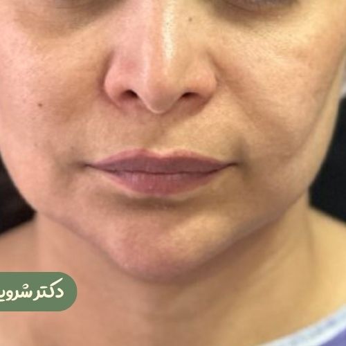 قبل از سانترال لب