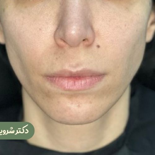قبل از سانترال لب