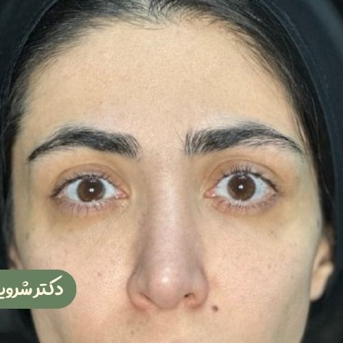 قبل از لیفت شقیقه