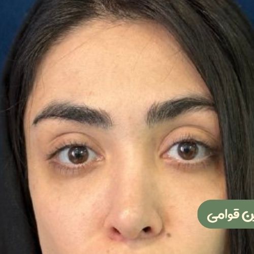 بعد از لیفت شقیقه