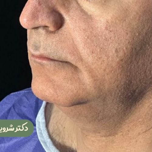 قبل از سانترال لب