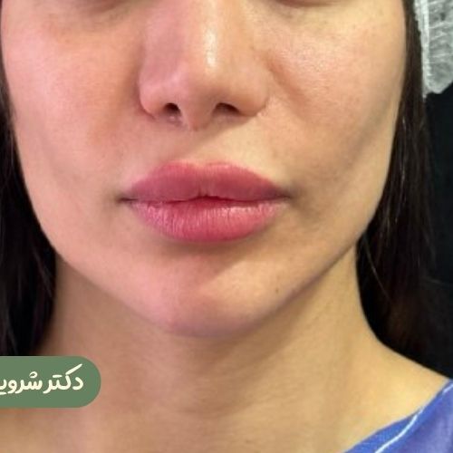 قبل از سانترال لب