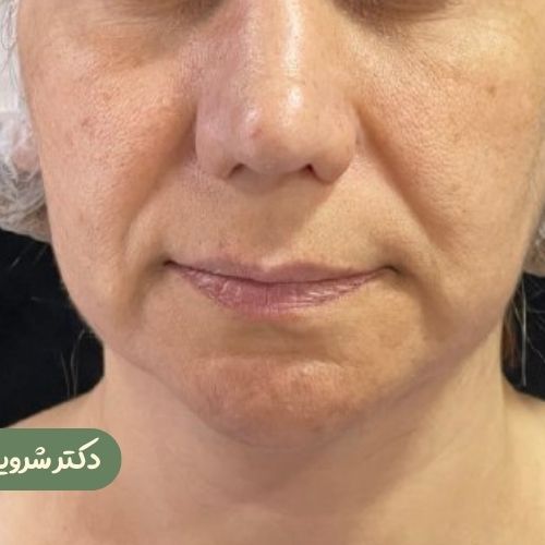 قبل از سانترال لب
