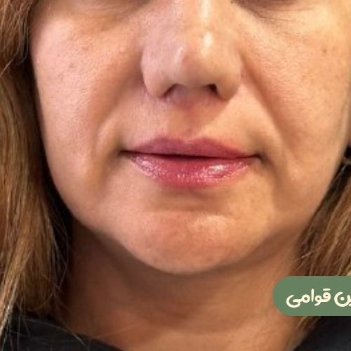 بعد از سانترال لب