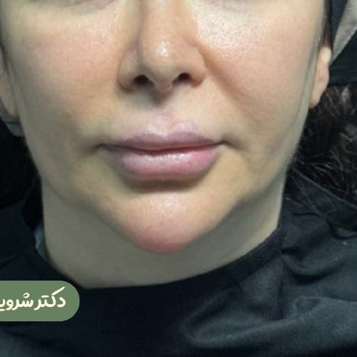 قبل از سانترال لب