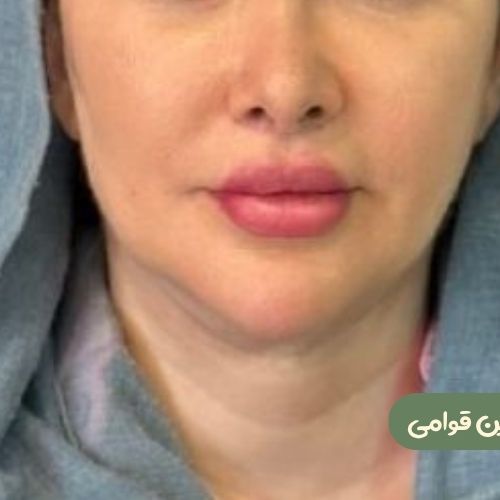 بعد از سانترال لب