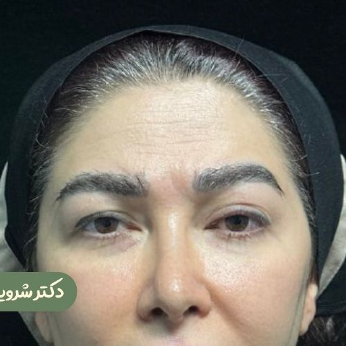 قبل از لیفت شقیقه + بلفاروپلاستی