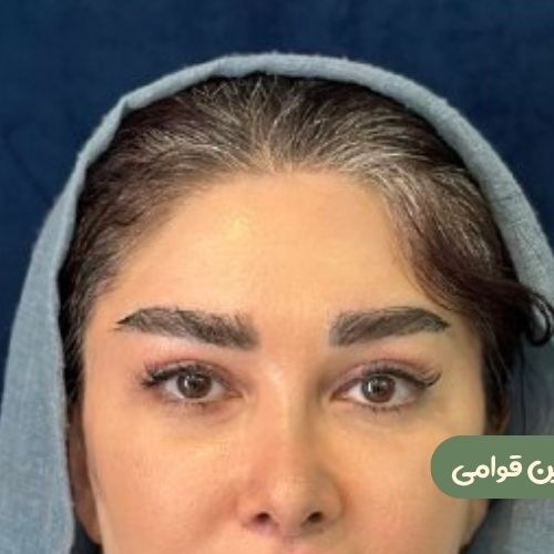 بعد از لیفت شقیقه + بلفاروپلاستی
