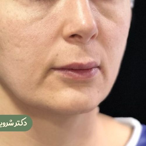 قبل از سانترال لب