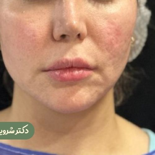 قبل از سانترال لب