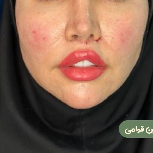 بعد از سانترال لب