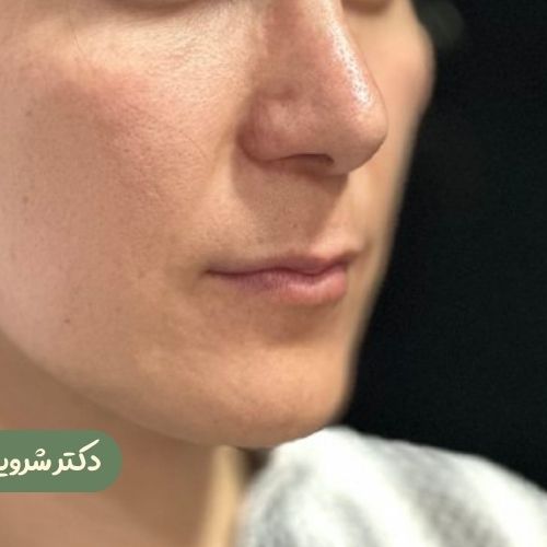 قبل از سانترال لب