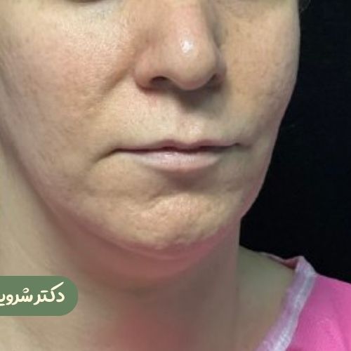 قبل از سانترال لب