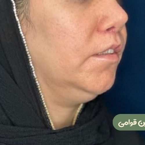 بعد از سانترال لب