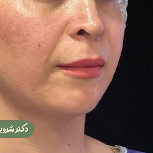 قبل از سانترال لب