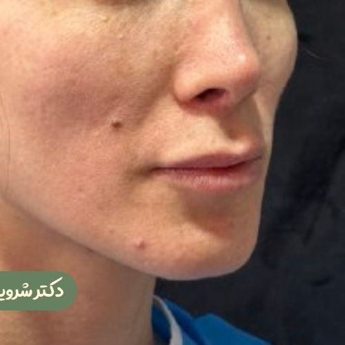 قبل از سانترال لب