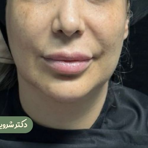قبل از سانترال لب