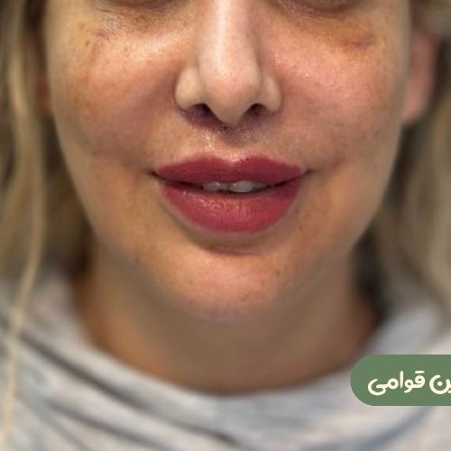 بعد از سانترال لب
