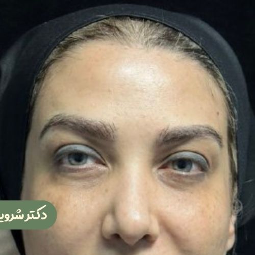 قبل از لیفت شقیقه