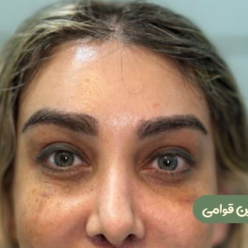 بعد از لیفت شقیقه