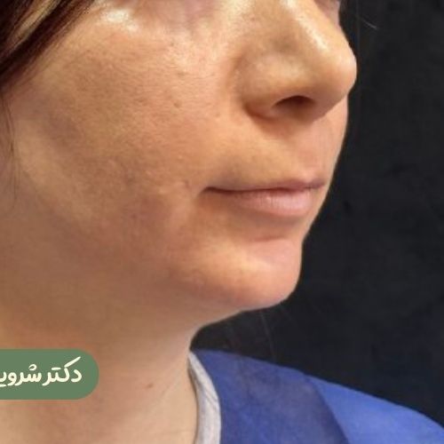 قبل از سانترال لب