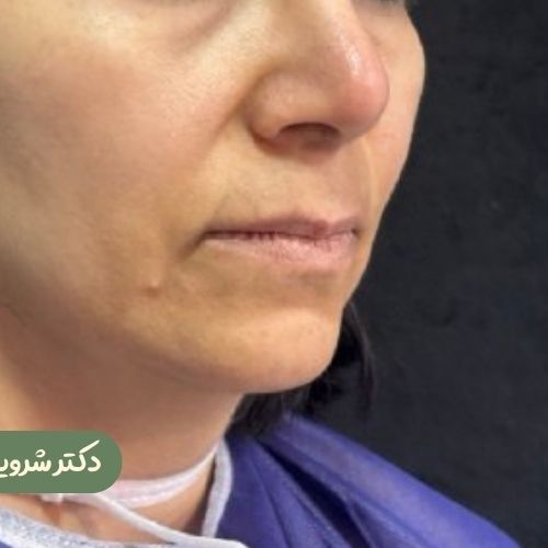 قبل از سانترال لب