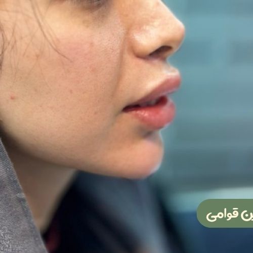 بعد از سانترال لب