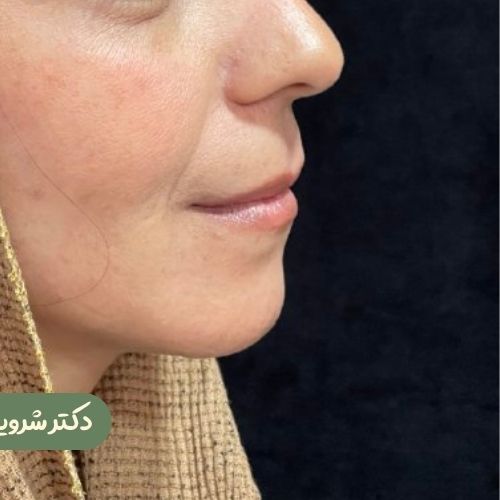 قبل از سانترال لب