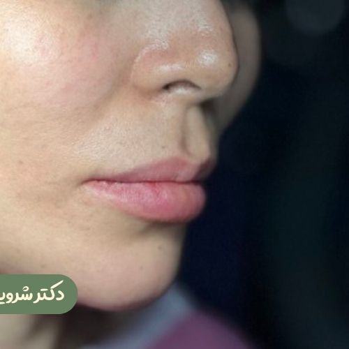 قبل از سانترال لب